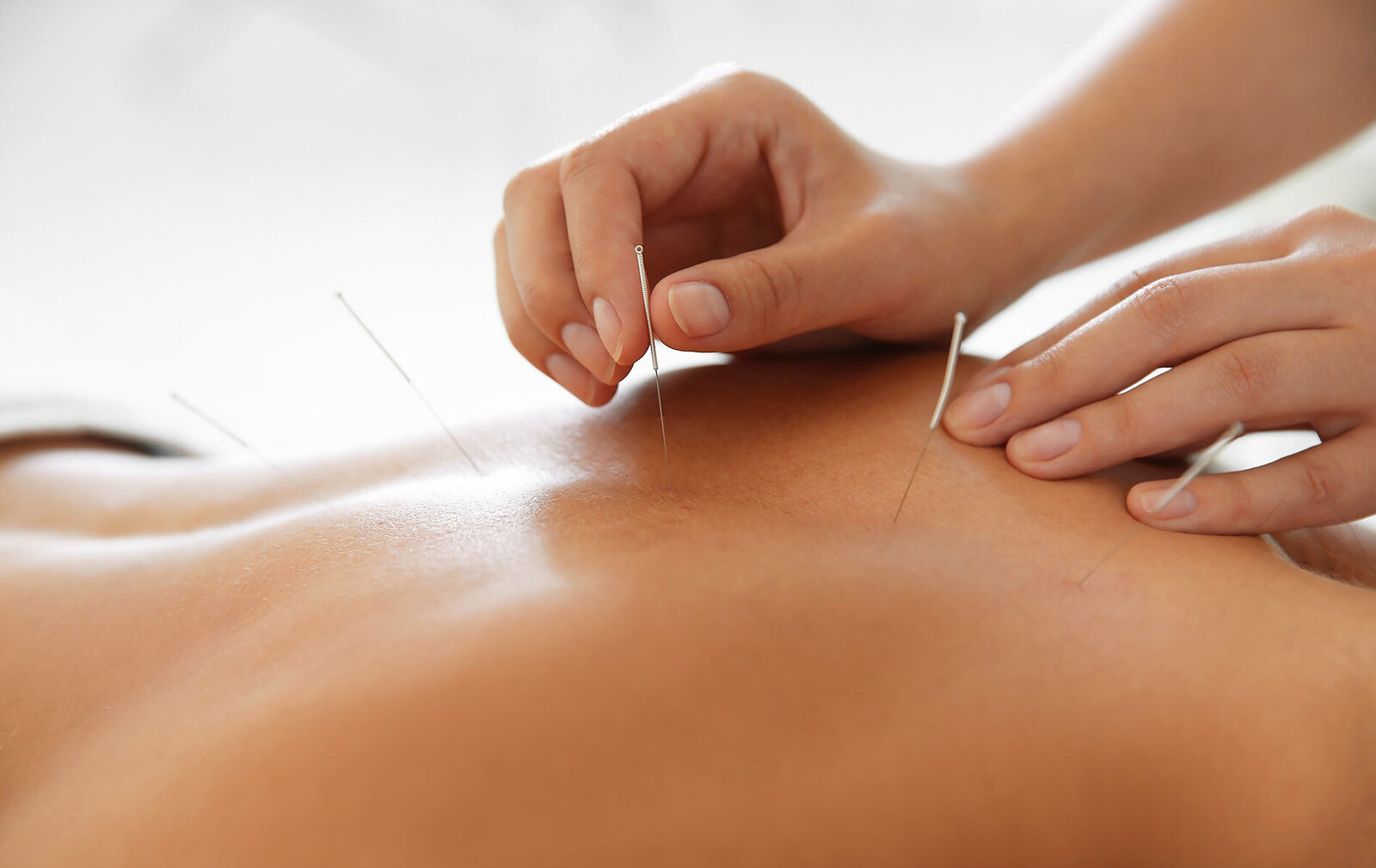 Eine Nahaufnahme von Händen, die sanft Akupunkturnadeln in den Rücken einer Person einführen. Die Umgebung ist ruhig und therapeutisch, was Entspannung und Heilung suggeriert.